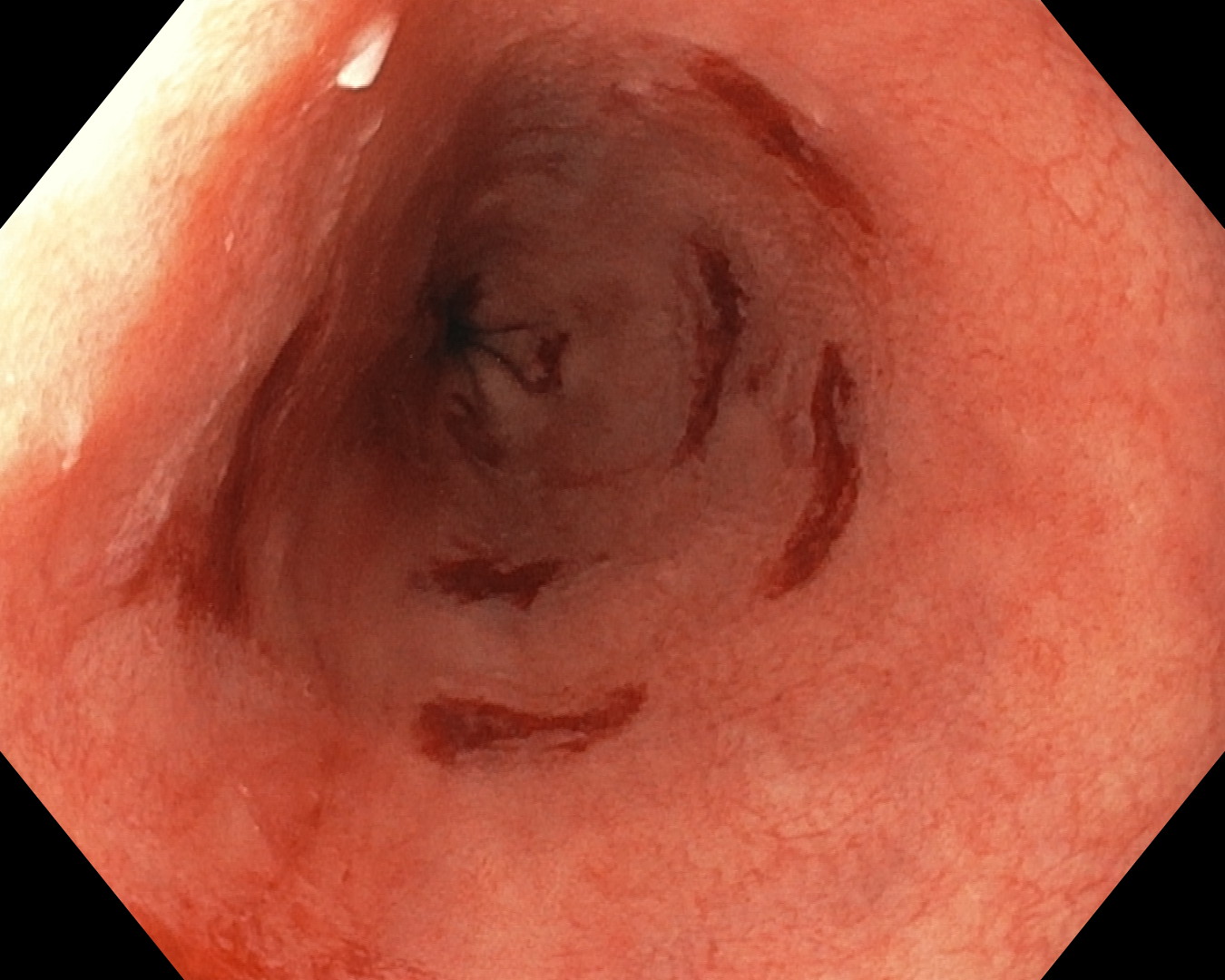 Endoscopic still of Barrett mucosa during Seattle-protocol forceps sampling, captured on an Olympus CV-190 processor.