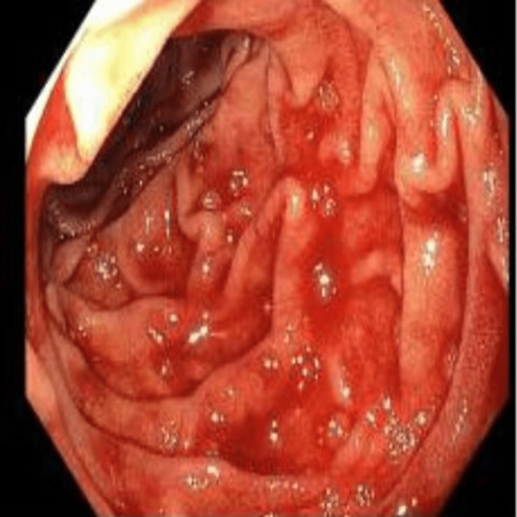 Endoscopic view of a bleeding Dieulafoy lesion in the second portion of the duodenum.